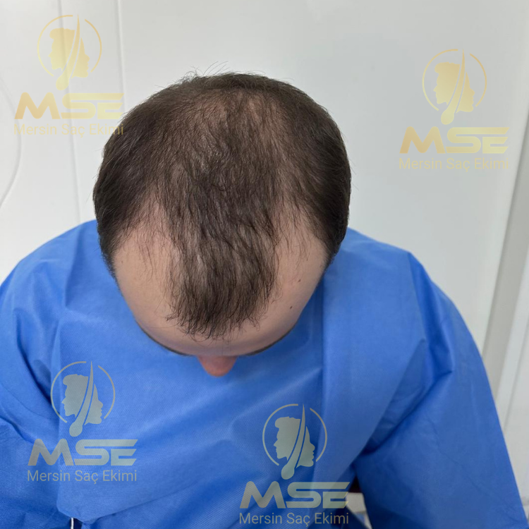 12. Ay Hastamızın Tedavisi Devam Ediyor. Öncesi